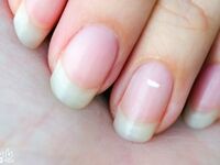 علت لکه‌های سفید روی ناخن چیست؟ / باور غلط درباره کمبود کلسیم